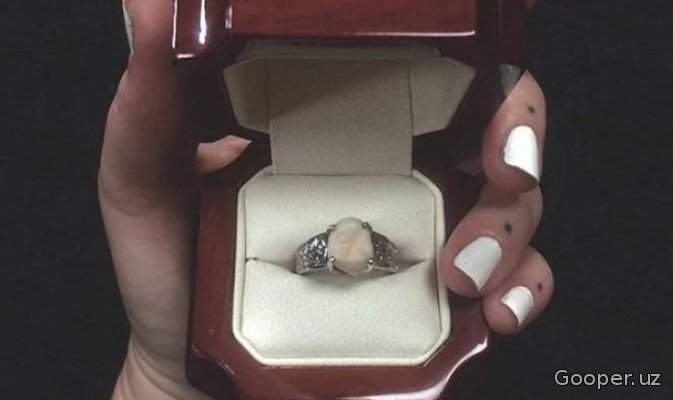 Amerikalik oshiq yigit sevgilisiga o'z tishi o'rnatilgan nikoh uzugi sovg'a qildi